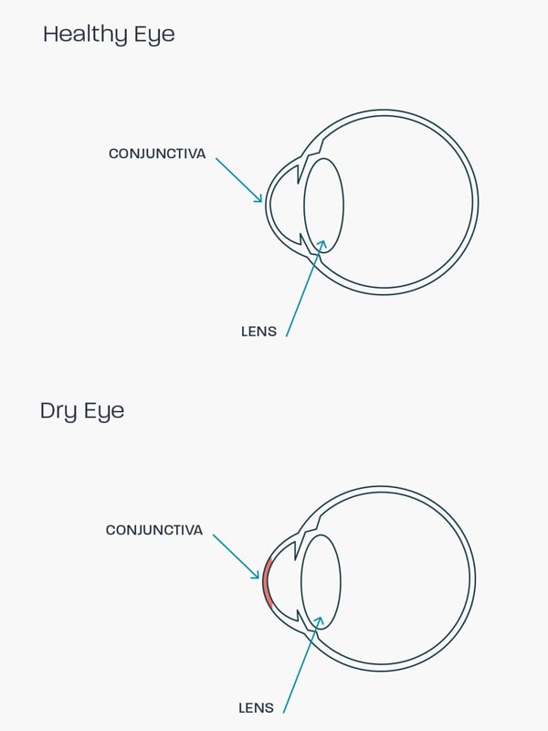 A graphic showing how dry eye syndrome affects the eye