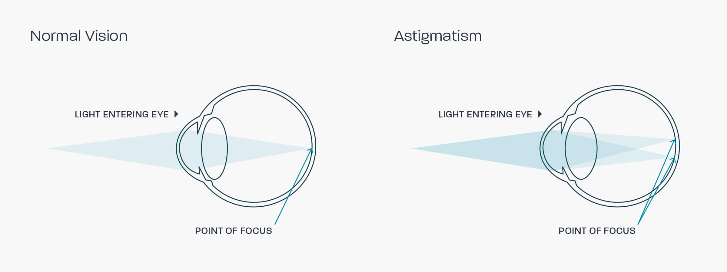 A graphic showing how astigmatism affects the eye