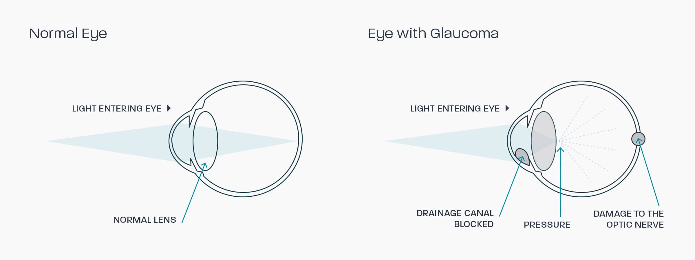 A graphic showing how glaucoma affects the eye