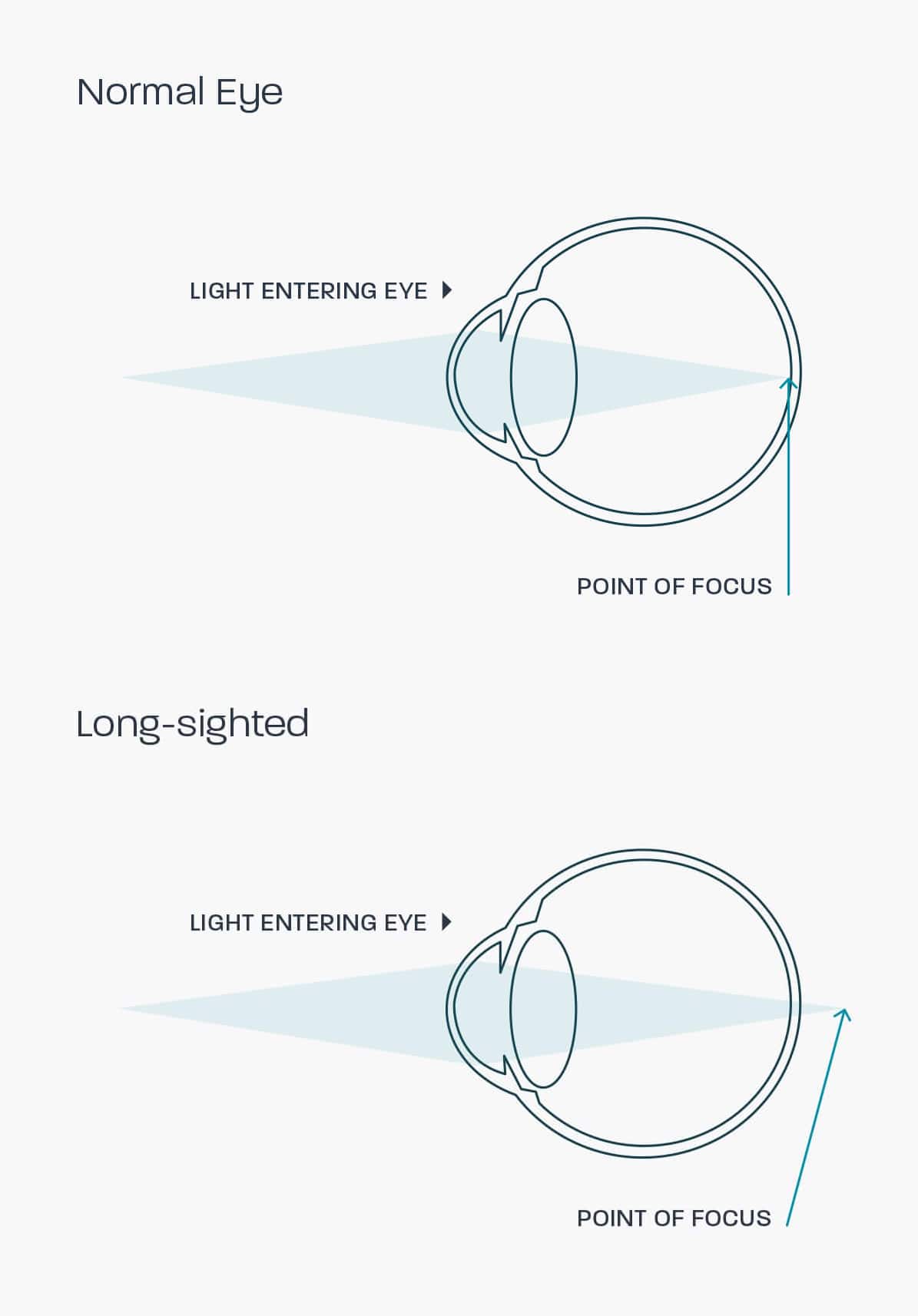 A graphic showing how a hyperopic eye works