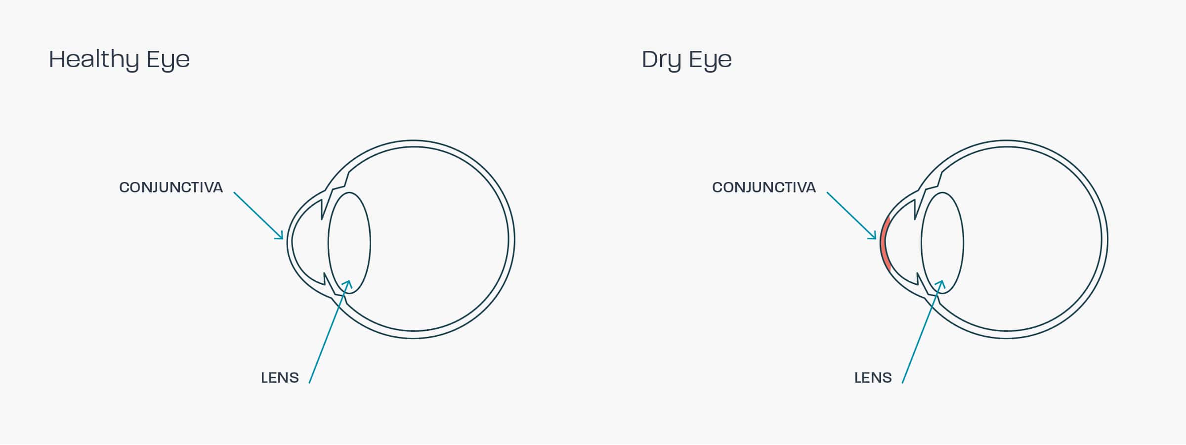 A graphic showing how dry eye syndrome affects the eye