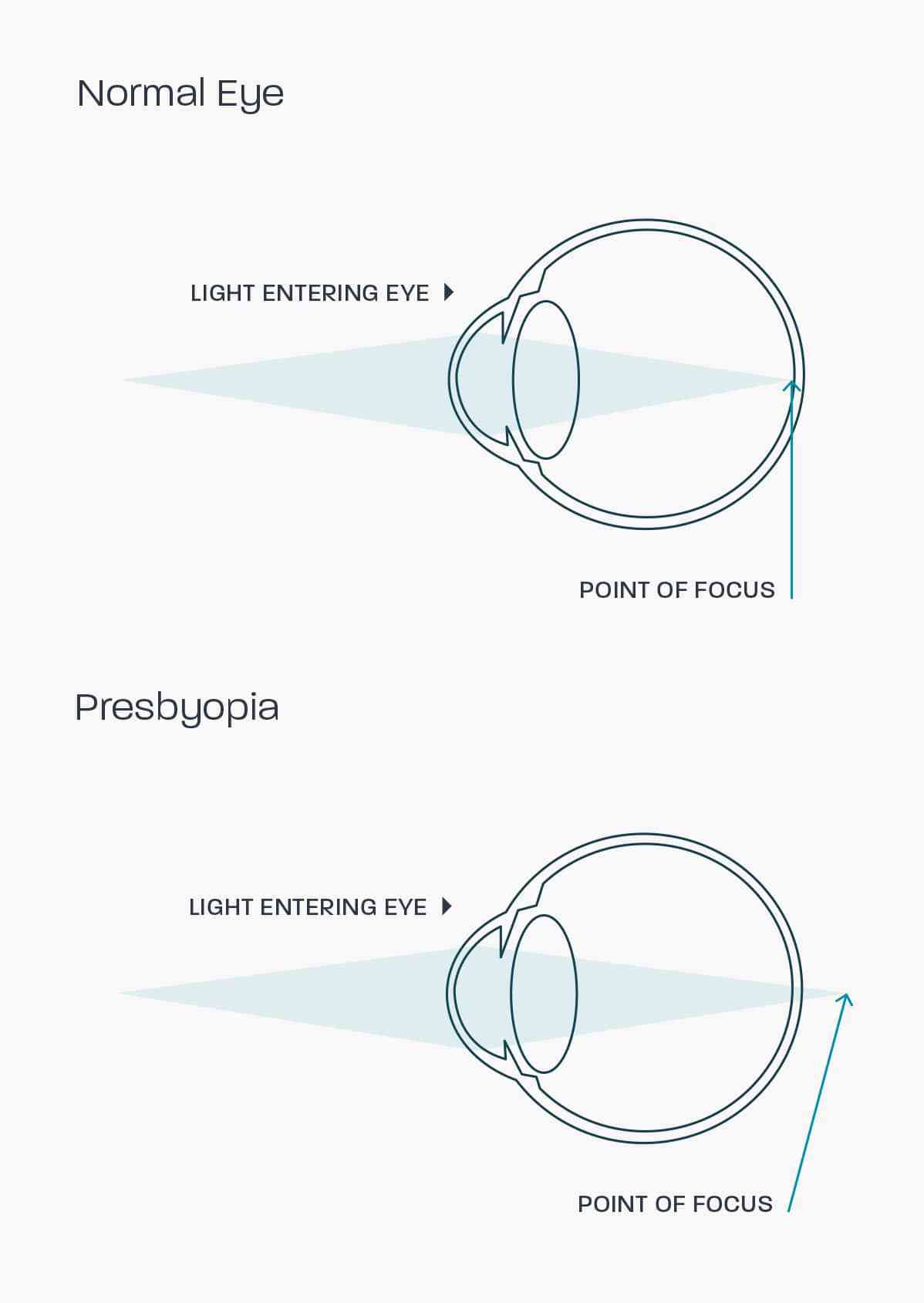 A graphic showing how presbyopia affects the eye