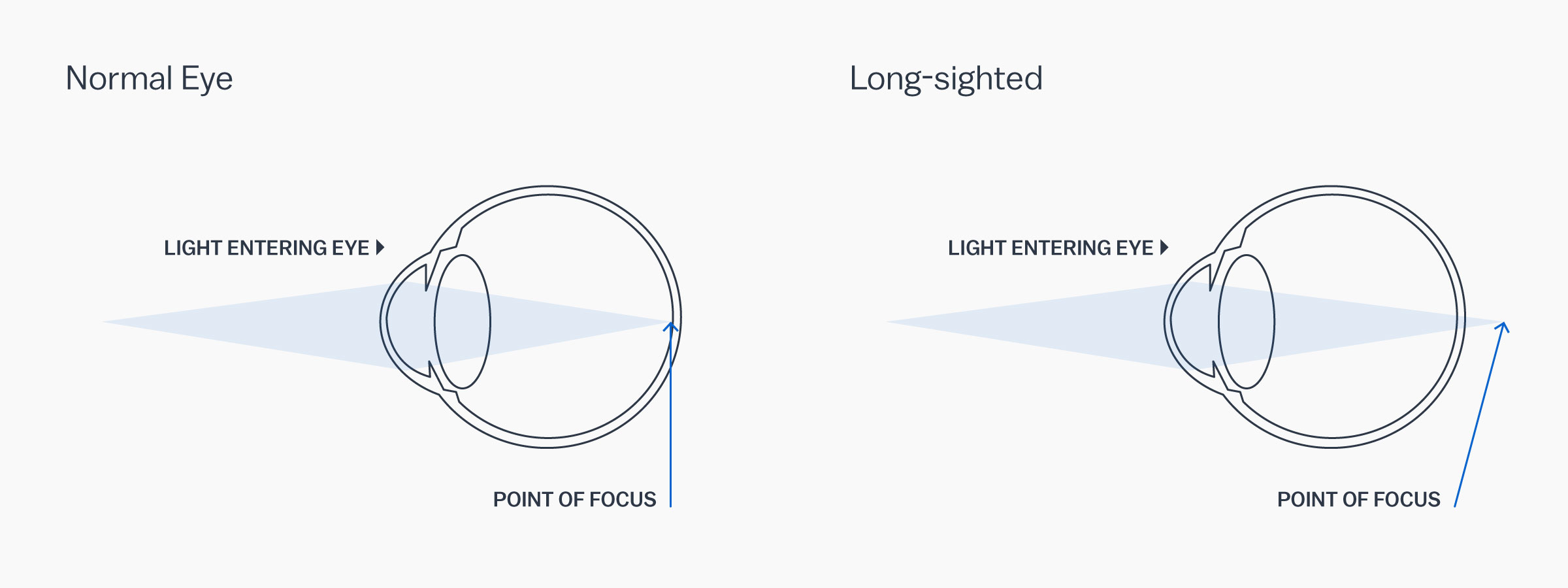 A graphic showing how a hyperopic eye works