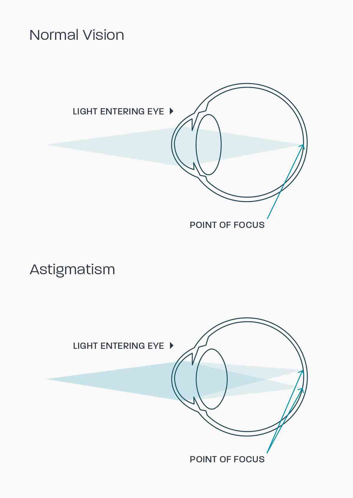 A graphic showing how astigmatism affects the eye