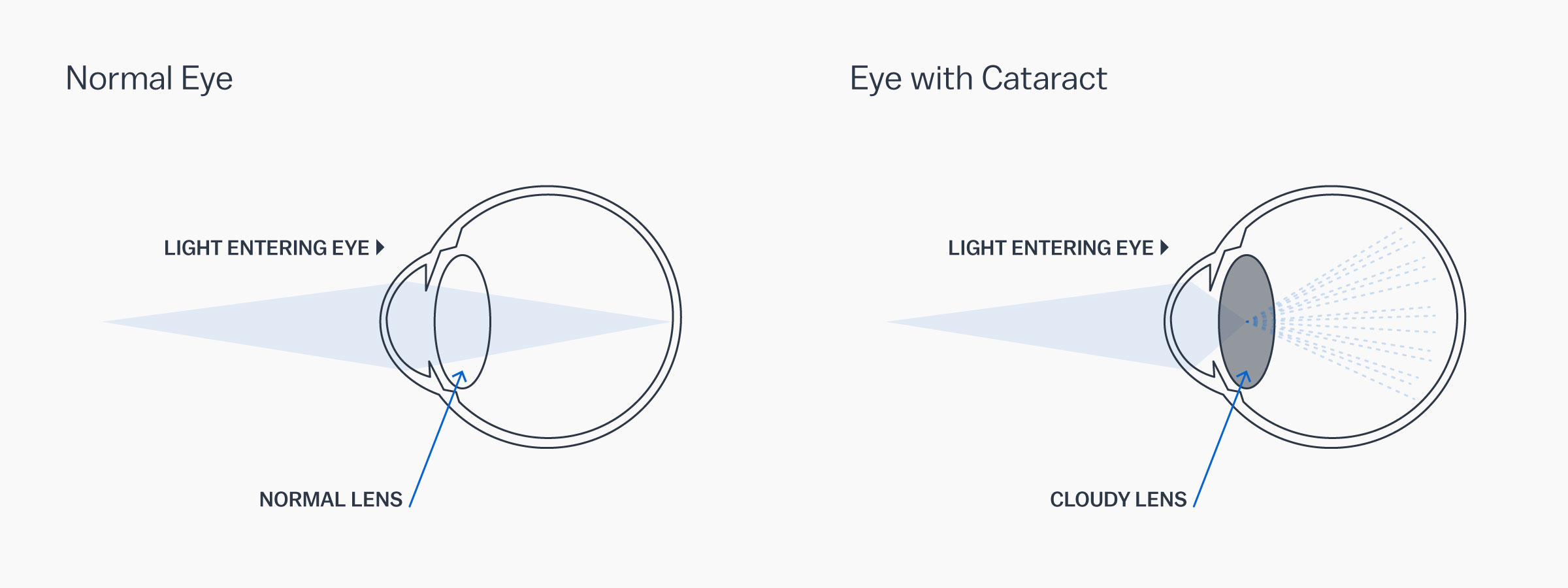 A graphic showing how a cataract affects the eye