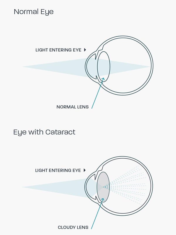 A graphic showing how cataracts affects the eye
