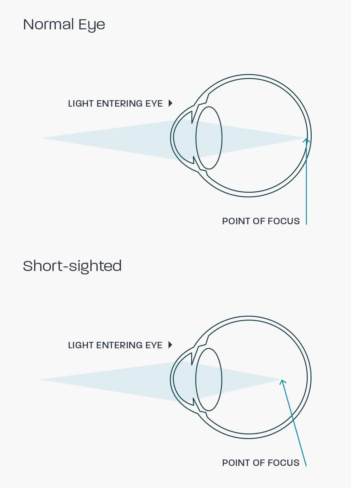 A graphic showing how a myopic eye works