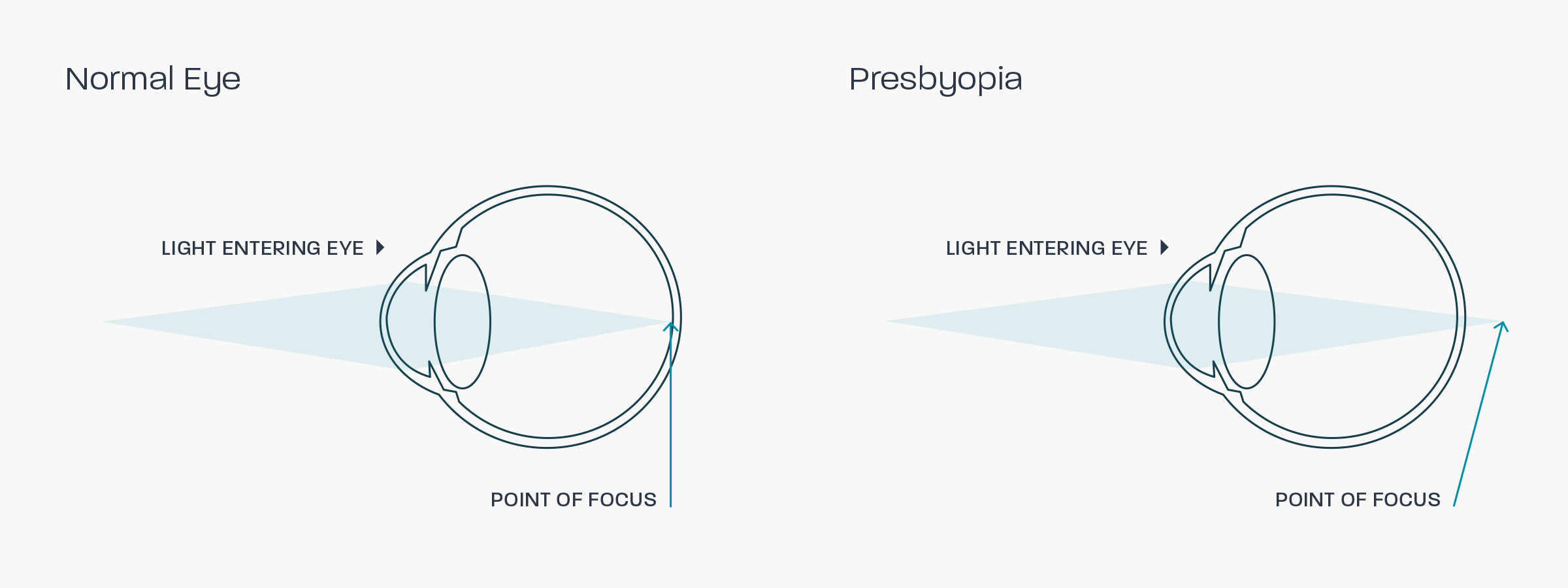 A graphic showing how presbyopia affects the eye
