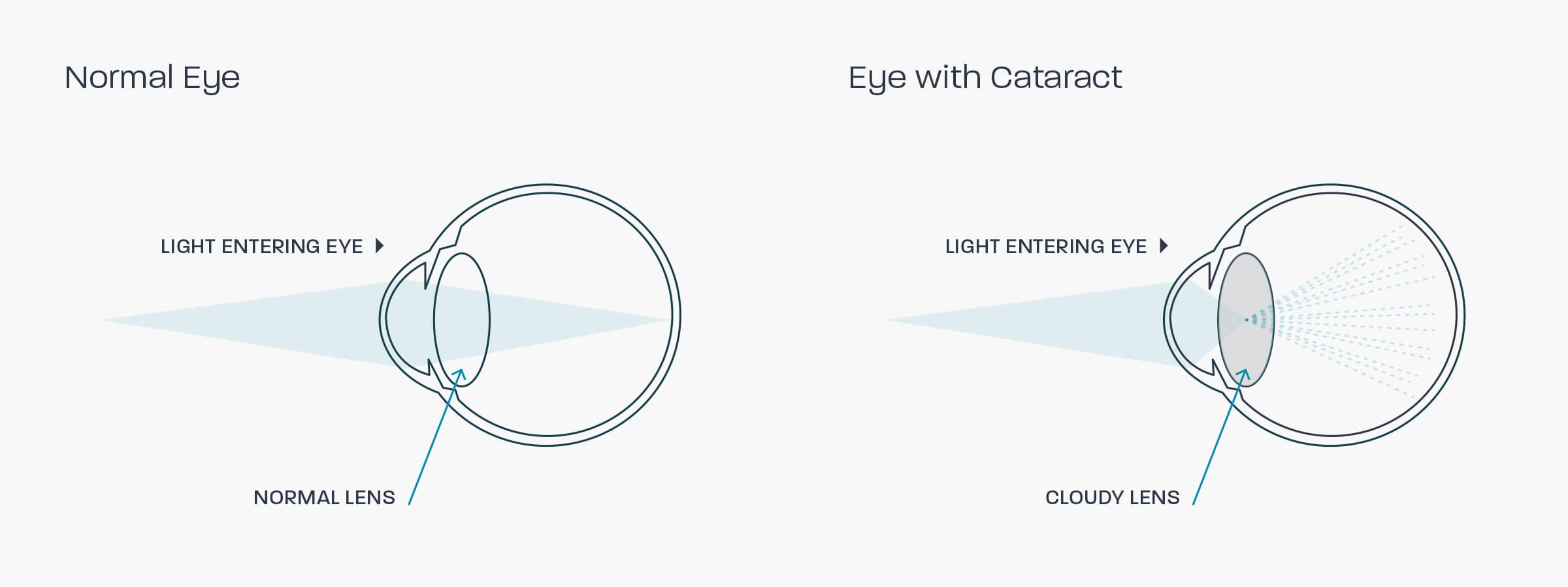 A graphic showing how cataracts affect the eye